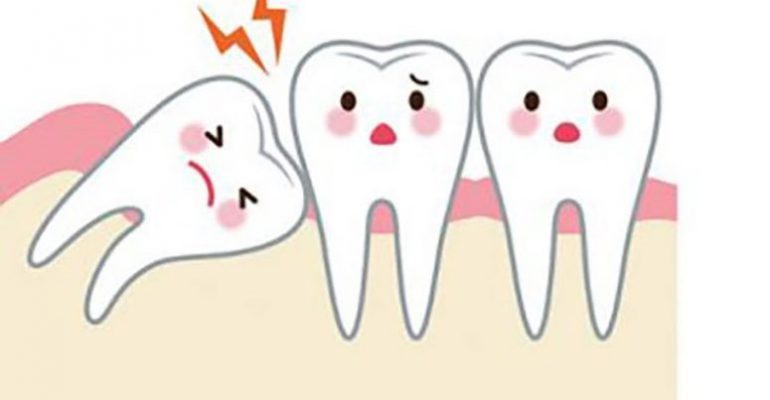 wisdom-tooth-extraction-time-1024x576